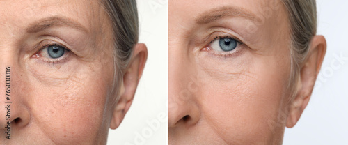 Aging skin changes. Collage with photos of mature woman before and after cosmetic procedure on white background, closeup photo
