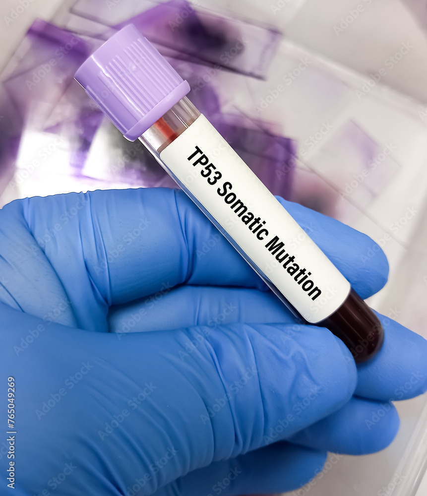 Blood sample for TP53 somatic mutation test, to determine risk of certain types of cancers. Li-Fraumeni syndrome. Blood sample for TP53 somatic mutation test, to determine risk of certain types of cancers. Li-Fraumeni syndrome.