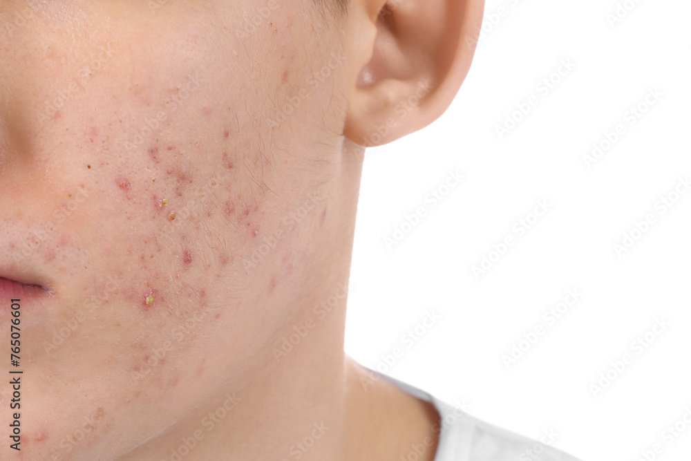 Fototapeta premium Young man with acne problem isolated on white, closeup
