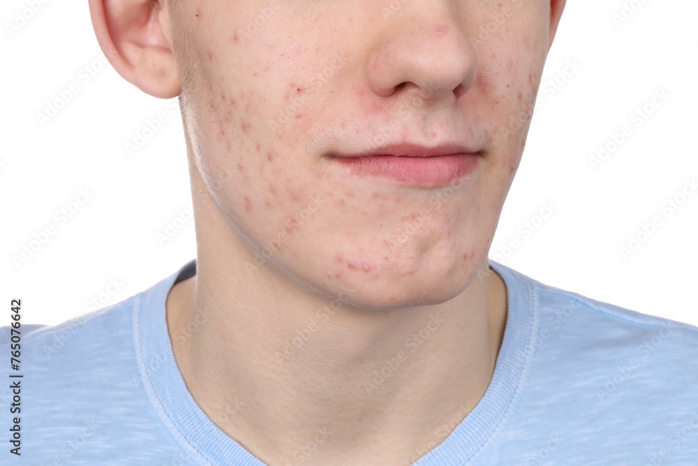Naklejka premium Young man with acne problem isolated on white, closeup