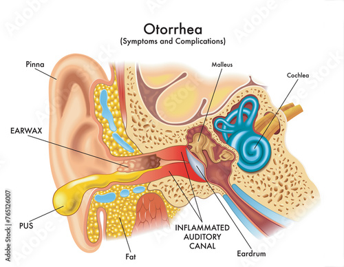 Medical illustration of some symptoms and complications of otorrhea, a pathology that affects the ear, with annotations.