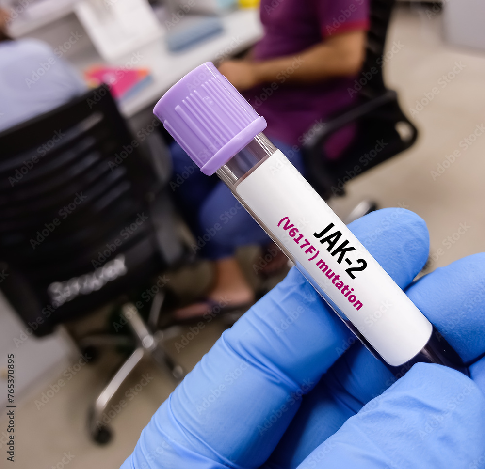 blood-sample-for-jak2-v617f-gene-test-to-diagnose-bone-marrow