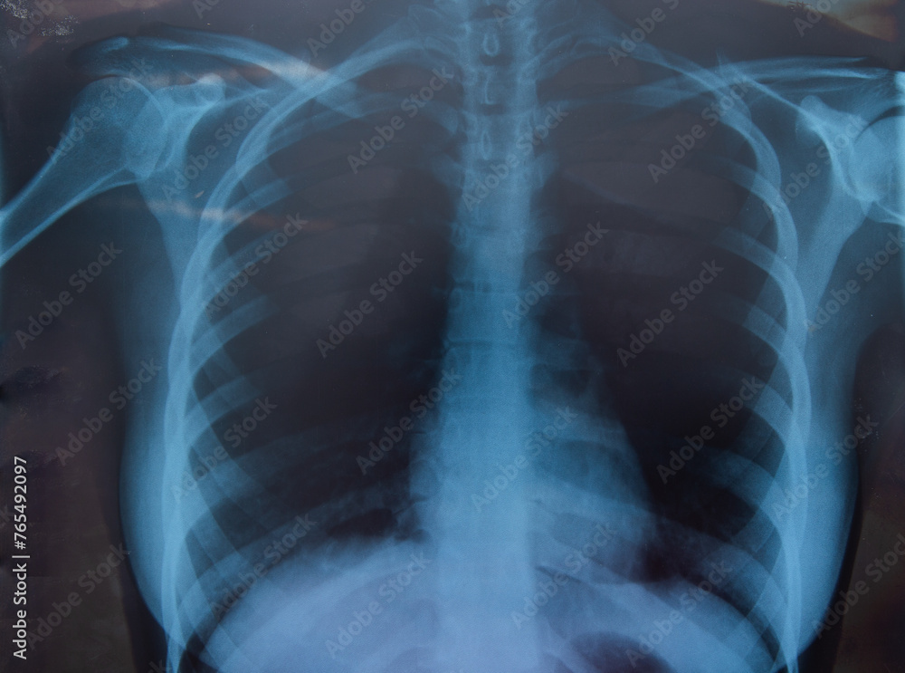 Woman xray for chest and lungs examination Woman xray for chest and lungs examination