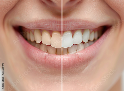 teeth_before_and_after 