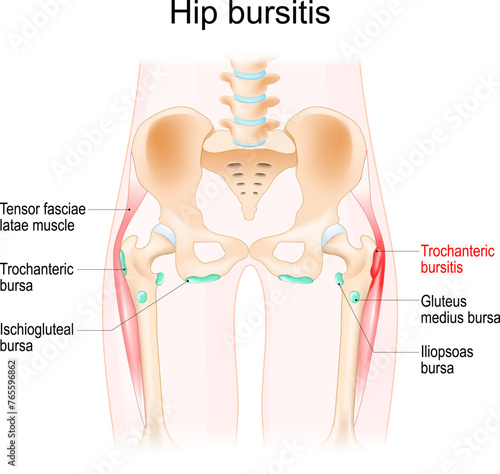 Hip bursitis. Muscles, Synovial bursas and bones of a human hip.
