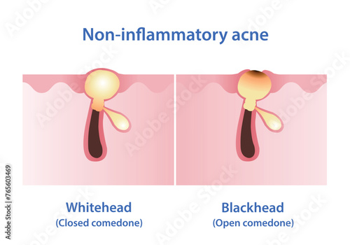 The difference between whitehead and blackhead acne vector illustration. Whitehead and blackhead are both types of non inflammatory acne, they are forms of comedones. The pore is closed or open.