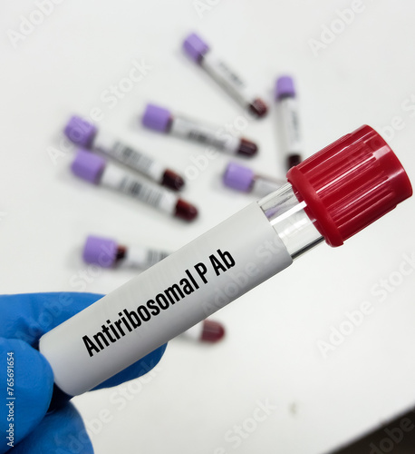 Blood sample for Anti-Ribosomal P (anti-Rib-B) testing to detect central nervous system systemic lupus erythematosus (SLE).
