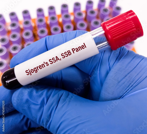 Blood sample for Sjogren's antibody panel test. Sjogren SSA, SSB. Anti-Ro and Anti-La test. photo