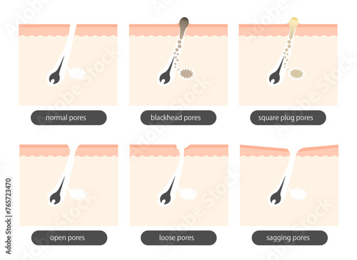毛穴の種類_Types of pores