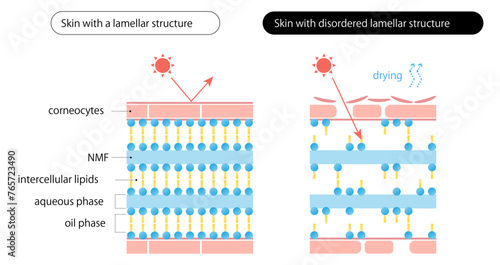 ラメラ構造が乱れた肌_Skin with disordered lamellar structure