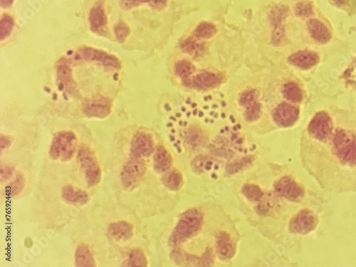 Canvas Print Neisseria gonorrhea - intracellular Gram negative diplococci