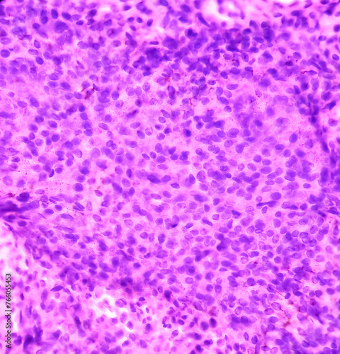 Parotid swelling cytology, Monomorphic adenoma. Smear show cellular material of epithelial cells in clusters and singly on the background of blood. photo