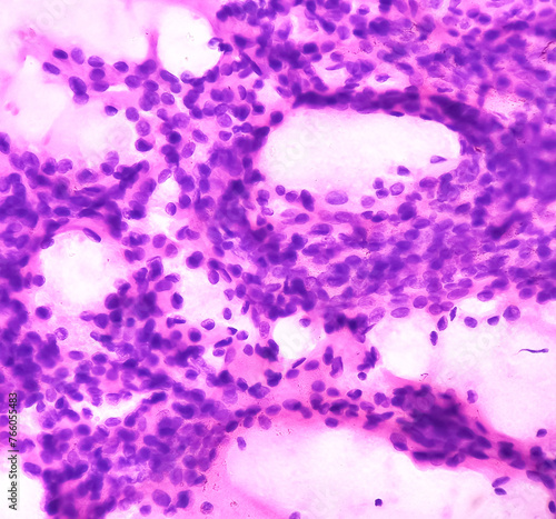 Parotid swelling cytology, Monomorphic adenoma. Smear show cellular material of epithelial cells in clusters and singly on the background of blood. photo