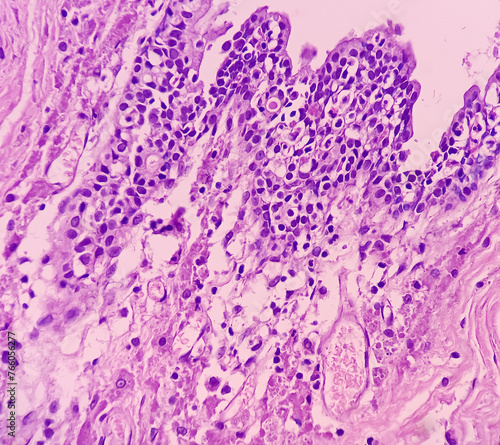 Urachal cyst or Urethral cyst (biopsy). Microscopically show cyst wall of fibrocollagenous tissue lined by transitional epithelium. Skene gland cysts. photo