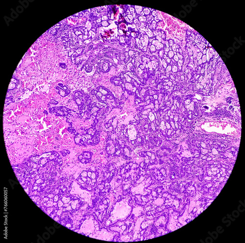Lung cancer - adenocarcinoma, mucinous type. Therapies for specific genetic mutations (biomarkers EGFR, ALK, ROS1, BRAF, PDL1, KRAS) are appropriate for selected cases. photo