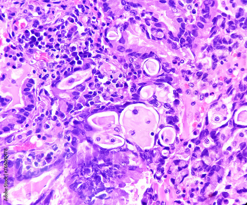 Lung cancer - adenocarcinoma, mucinous type. Therapies for specific genetic mutations (biomarkers EGFR, ALK, ROS1, BRAF, PDL1, KRAS) are appropriate for selected cases. photo