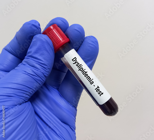 Blood sample for Dyslipidemia test. Dyslipoproteinemia. Hyperlipidemia. Lipid profile. photo