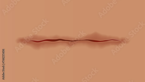 Healing wounds, skin scar, stitched gash and cut. Realistic surgical suture, stitched wounds. Healing stage on human skin background. Vector illustration