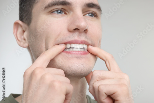 Young man applying whitening strip on his teeth against light grey background, closeup. Space for text