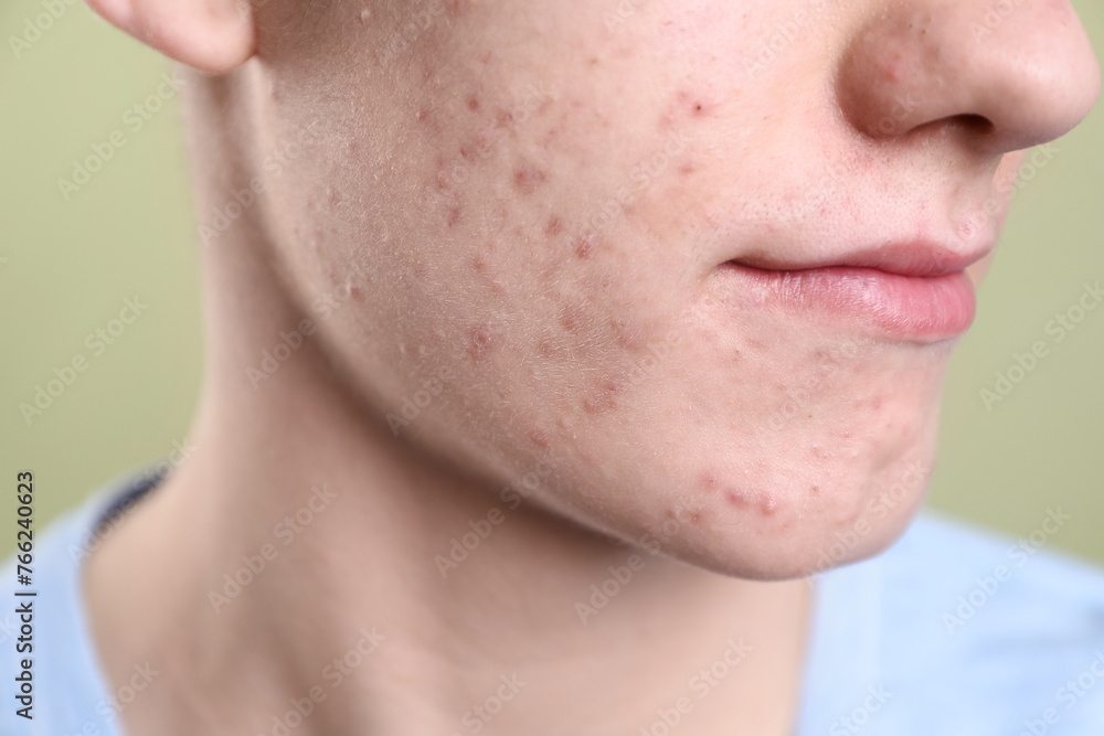 Obraz premium Young man with acne problem on olive background, closeup