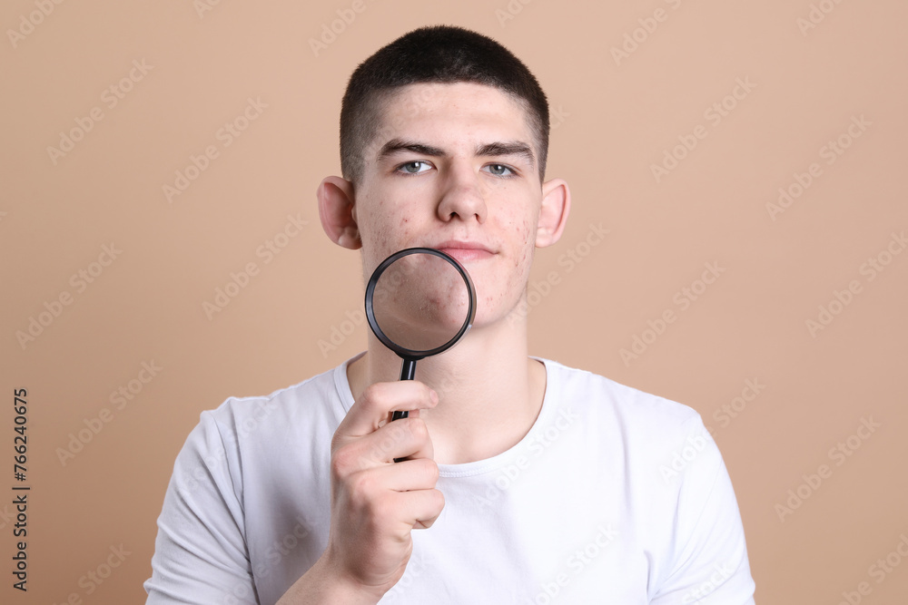 Young man with acne problem holding magnifying glass on beige background Young man with acne problem holding magnifying glass on beige background