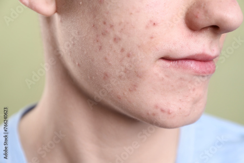 Young man with acne problem on olive background, closeup