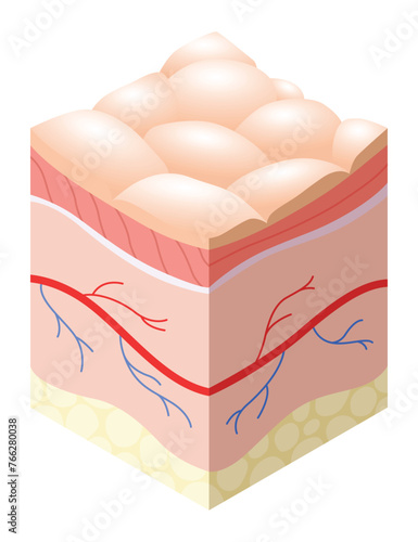 Skincare medical concept. Problems in cross-section of human skin horizontal layers structure. Anatomy illustrative model unhealthy layer of skin