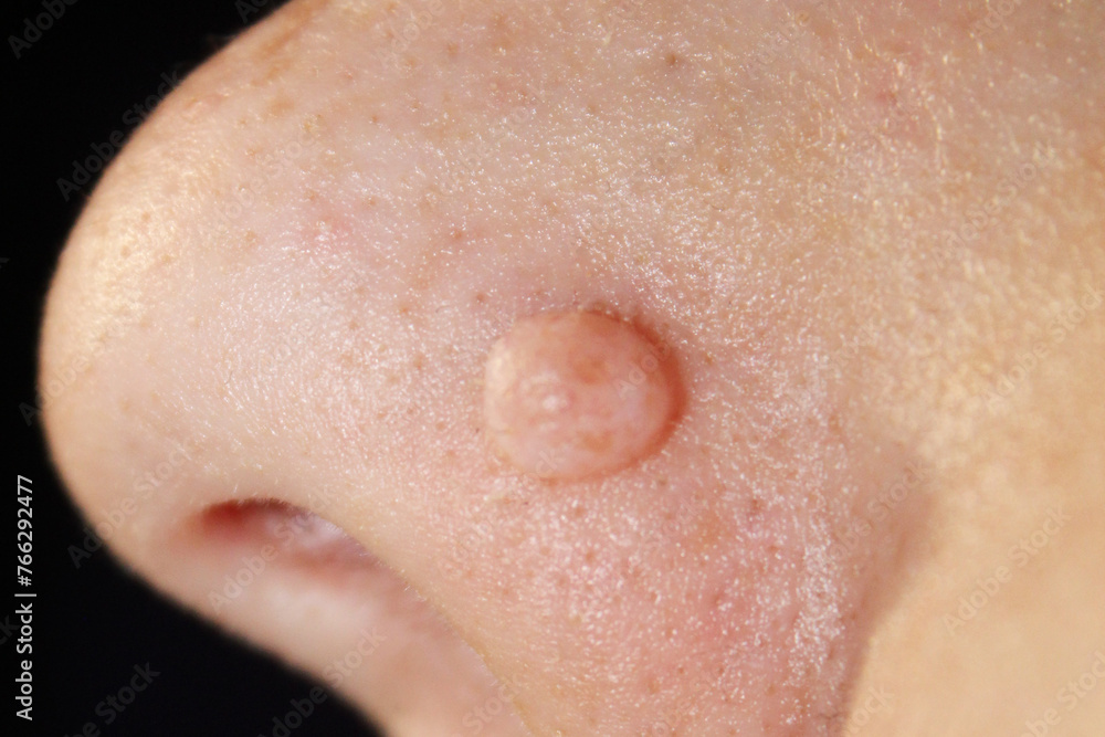 Fototapeta premium Wart on the nose close-up on a black background. Stock photo of a large mole on a person's body. Best quality.