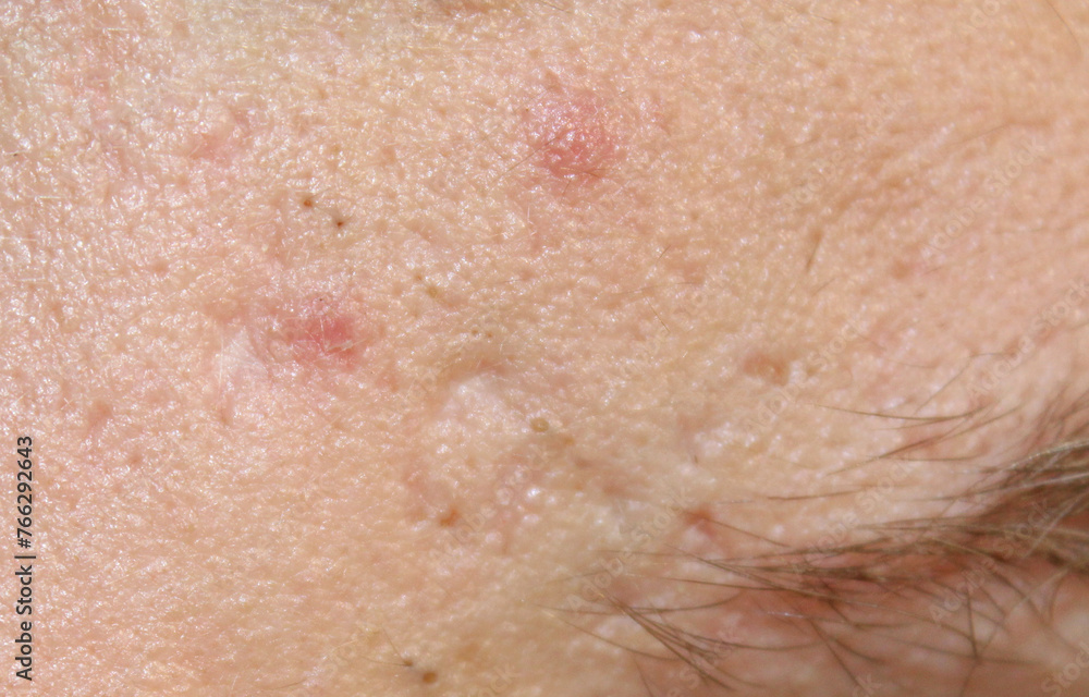 Fototapeta premium Problem skin with acne on the body. Stock human skin texture in the best quality. Photo with scars.