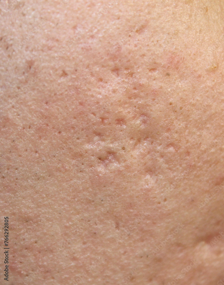 Problem skin with acne marks. Stock human skin texture in the best quality. Photo with scars. Problem skin with acne marks. Stock human skin texture in the best quality. Photo with scars.