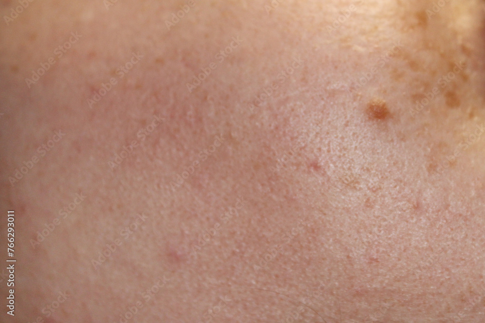 Skin texture of a girl with freckles and a birthmark close-up. Close-up stock photo of human skin in best quality.