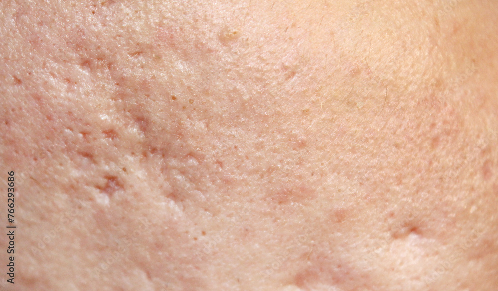 Problem skin with acne marks. Stock human skin texture in the best quality. Photo with scars. Problem skin with acne marks. Stock human skin texture in the best quality. Photo with scars.