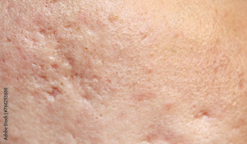 Problem skin with acne marks. Stock human skin texture in the best quality. Photo with scars.