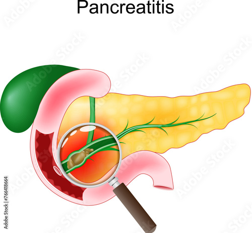 Acute pancreatitis. Close-up of a realistic pancreas, duodenum, and gallbladder