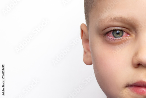 Closeup of a child's face with a red eye, isolated on a white background with copy space. Swelling of the eyelids, irritation and itching of the eyes caused by conjunctivitis, inflammation, infection photo