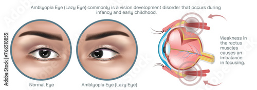 Amblyopia, often referred to as lazy eye is a condition characterized by reduced vision in one or both eyes that is not due to any structural abnormalities of the eye vector illustration.