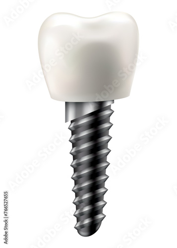 Fototapeta Naklejka Na Ścianę i Meble -  Dental implant structure. Medical educative infographic poster. Teeth implant, realistic  design of dentistry. Implant screw, healthcare, dentist and orthodontist treatment