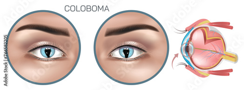Coloboma is a congenital condition characterized by a gap or notch in one of the eyes structures, typically affecting the iris, retina, choroid, or optic disc. eye diseases and syndromes vector