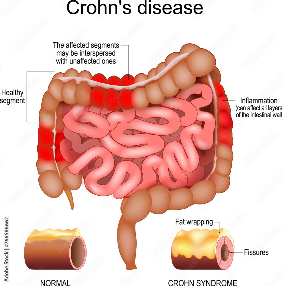 Crohn disease. intestine with Inflammation - obrazy, fototapety, plakaty 