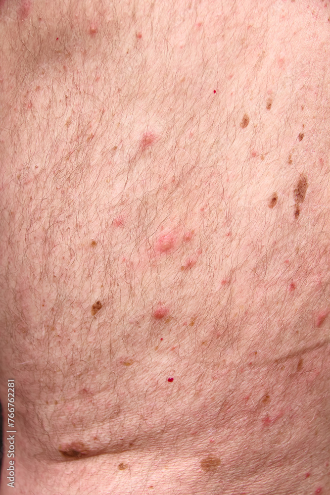 Man skin background have red rash from allergic soap