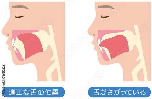 正しい舌の位置と下がっている舌の位置 photo