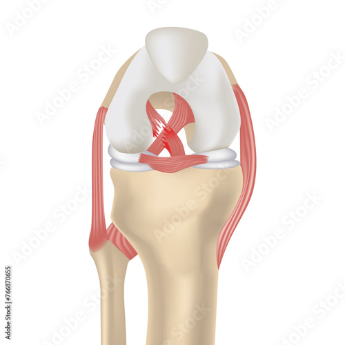 Cruciate ligament rupture. Realistic rendering of the knee joint, drawer syndrome. Medical poster. Vector illustration