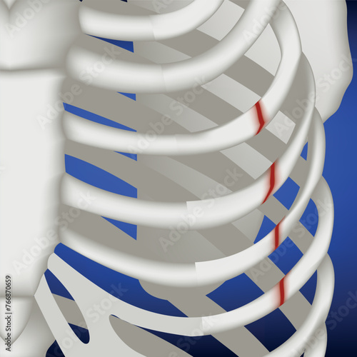 Broken ribs on a blue background, close-up. Medical poster, vector isolated illustration