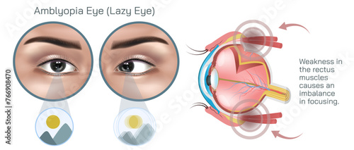 Amblyopia, often referred to as lazy eye is a condition characterized by reduced vision in one or both eyes that is not due to any structural abnormalities of the eye vector illustration.