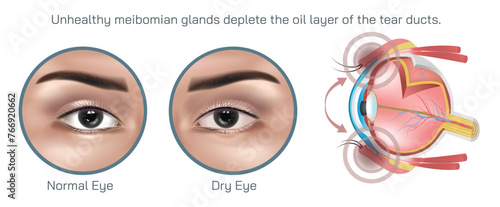 Dry eye syndrome, also known as dry eye disease is a common condition that occurs when the eyes do not produce enough tears or when the tears evaporate too quickly. lubrication of the eyes vector
