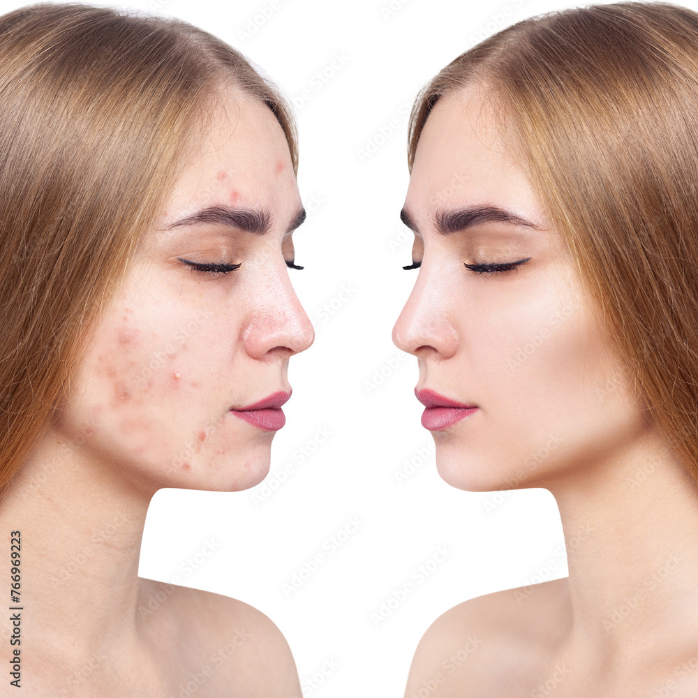 Young woman before and after acne treatment. Young woman before and after acne treatment.