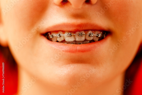 Close-up of a teenager mouth with dental braces.