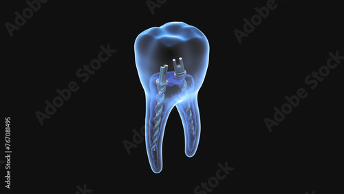 Dental steel post inside molar teeth, Xray view. Dental endodontic treatment 3D render illustration
