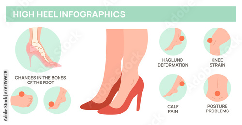 High heels harm for female feet. Foot disease medical poster. Deformity of bones and joints. Orthopedic problem. Uncomfortable woman footgear. Anatomy infographic. Garish vector concept
