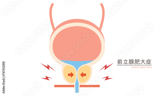 前立腺肥大症の医療イラスト、正常な前立腺と肥大した前立腺の比較